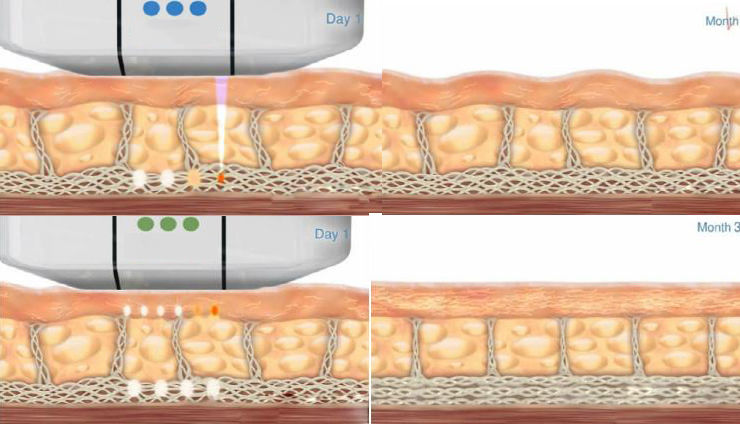 Pro High intensity focused ultrasound HIFU Face lifting Beauty Care Spa Machine DIAGNOSTIC ULTRASOUND MACHINES FOR SALE