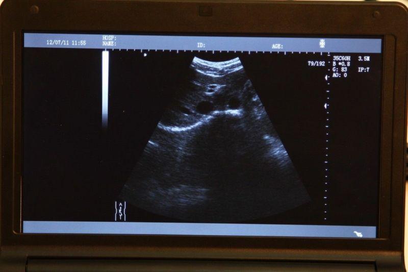 Full Digital Laptop Ultrasound Scanner scan system 6.5MHz transvaginal Probe CE 190891827180 DIAGNOSTIC ULTRASOUND MACHINES FOR SALE