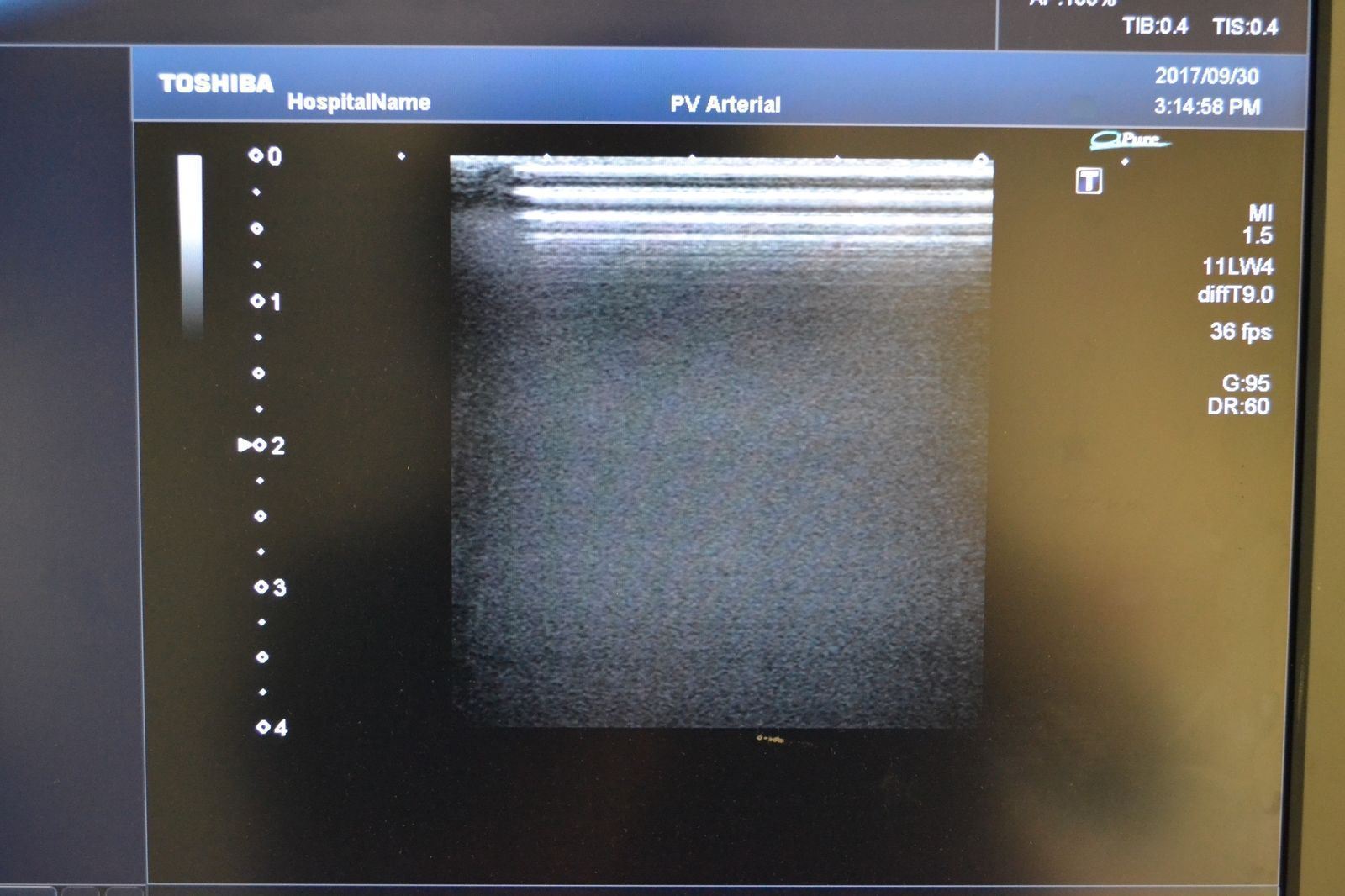 Toshiba Artida PLT-704SBT 11-4.8MHz Linear Ultrasound Transducer Probe J1624 DIAGNOSTIC ULTRASOUND MACHINES FOR SALE