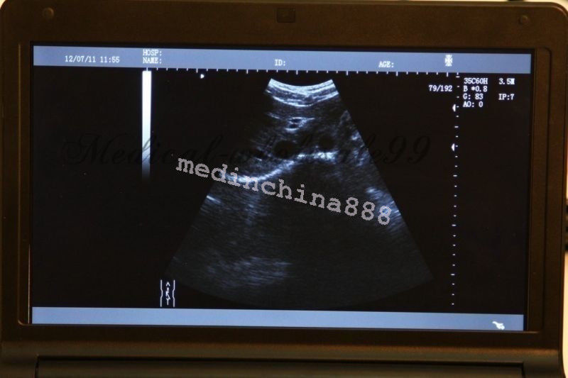 Digital LCD Ultrasound Scanner Machine+Convex + Linear Probe+Sony Printer 190891246417 DIAGNOSTIC ULTRASOUND MACHINES FOR SALE