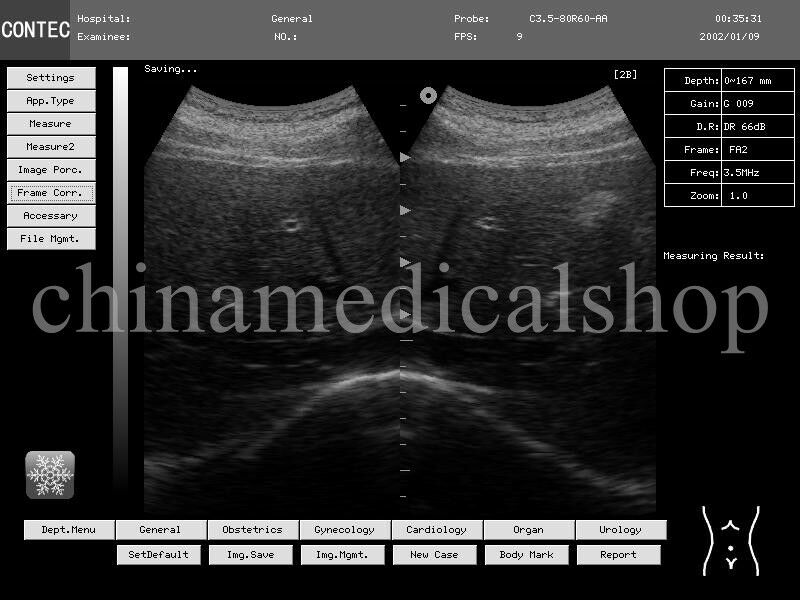 Portable Ultrasound scanner Laptop machine tow probes 3.5M convex 7.5M linear US DIAGNOSTIC ULTRASOUND MACHINES FOR SALE