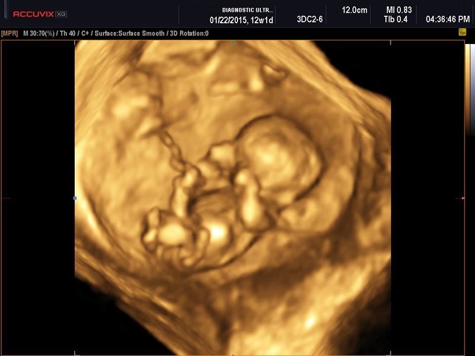 Samsung Medison Accuvix XG with 3D/4D convex probe DIAGNOSTIC ULTRASOUND MACHINES FOR SALE