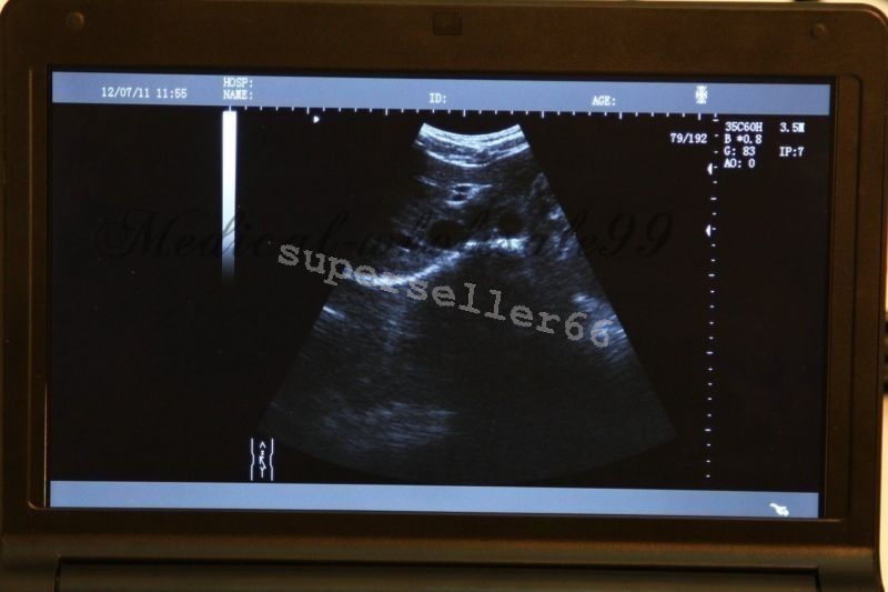 Digital LCD Monitor Ultrasound Scanner+Convex Linear Probe+Sony UP-897MD Printer DIAGNOSTIC ULTRASOUND MACHINES FOR SALE
