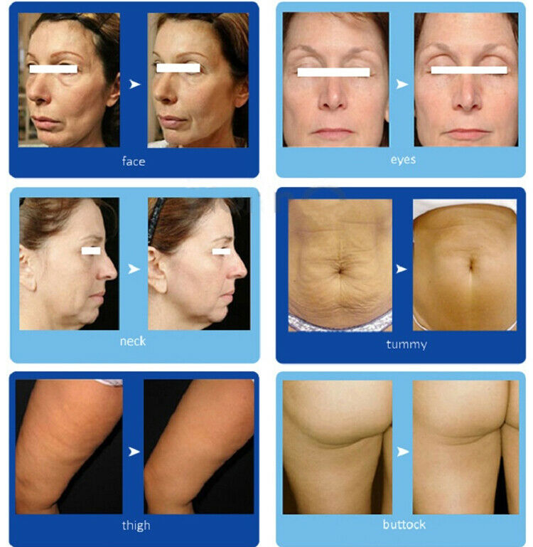 Portable Exilis Body Sculpting Ultrasound Radio Frequency Device body slim DIAGNOSTIC ULTRASOUND MACHINES FOR SALE