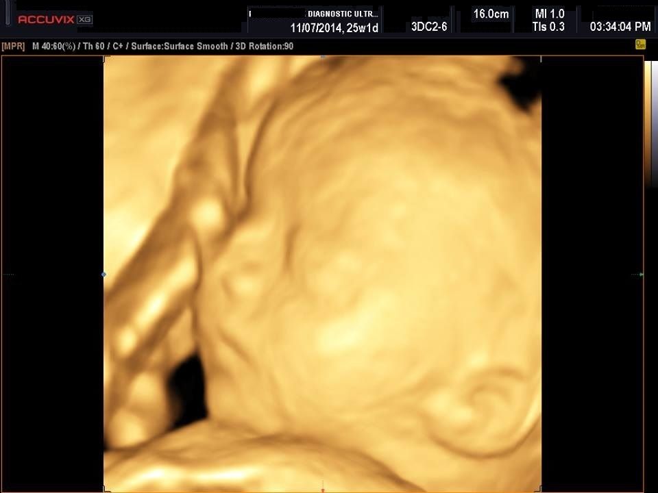 Samsung Medison Accuvix XG with 3D/4D convex probe DIAGNOSTIC ULTRASOUND MACHINES FOR SALE