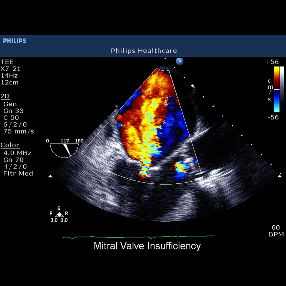 Philips CX50 Portable Ultrasound System with S5-1 Cardiac Sector Transducer DIAGNOSTIC ULTRASOUND MACHINES FOR SALE