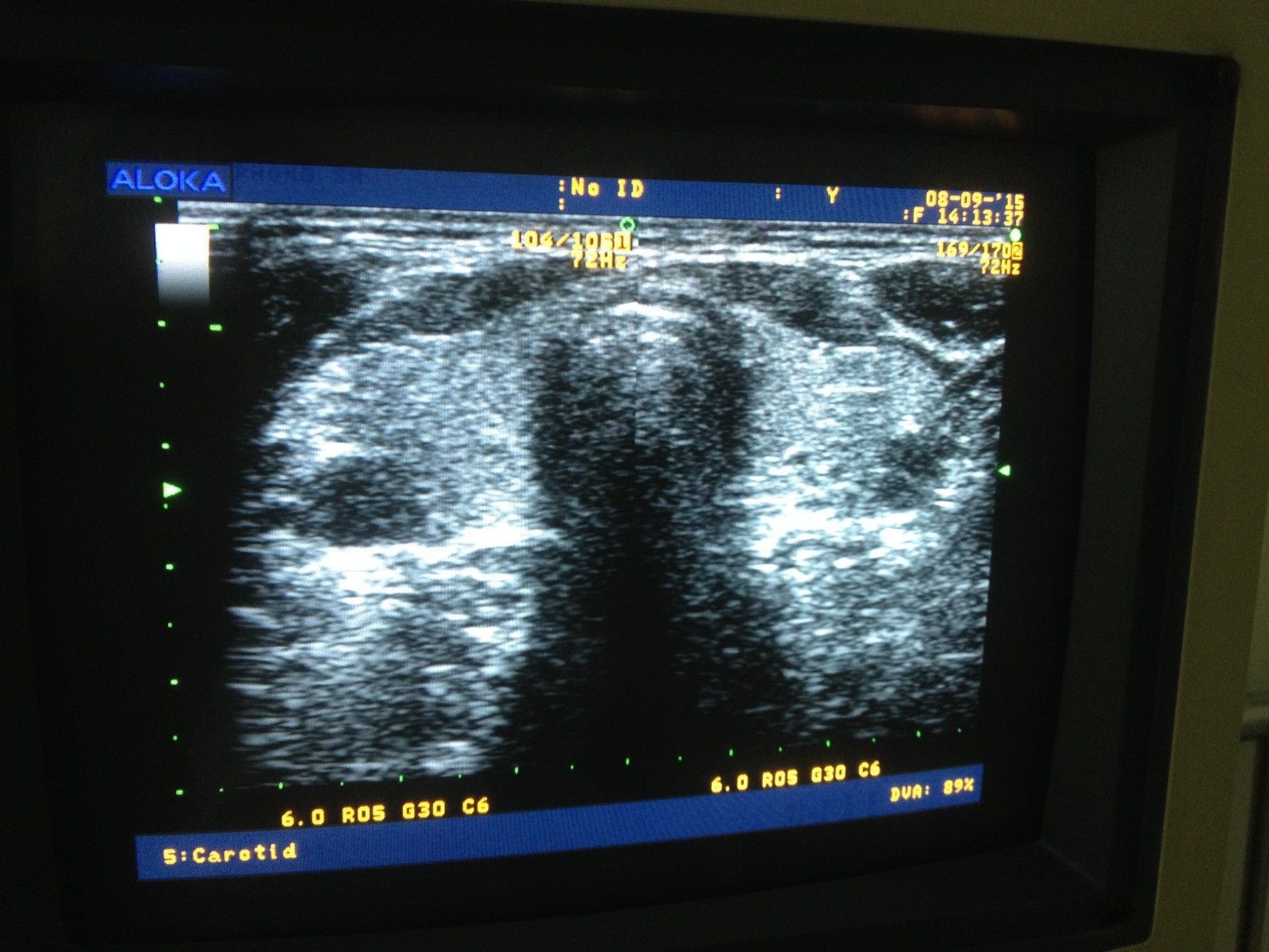 Compatible Hitachi Aloka ultrasound UST 5546 linear probe DIAGNOSTIC ULTRASOUND MACHINES FOR SALE