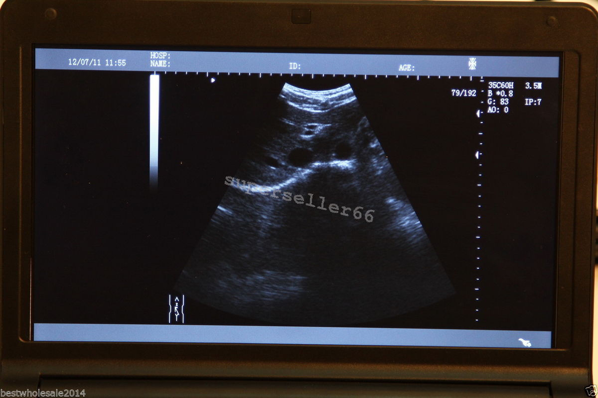 Digital LCD Ultrasound Scanner B Ultrasonic Machine,Convex Probe ,Linear Probe DIAGNOSTIC ULTRASOUND MACHINES FOR SALE