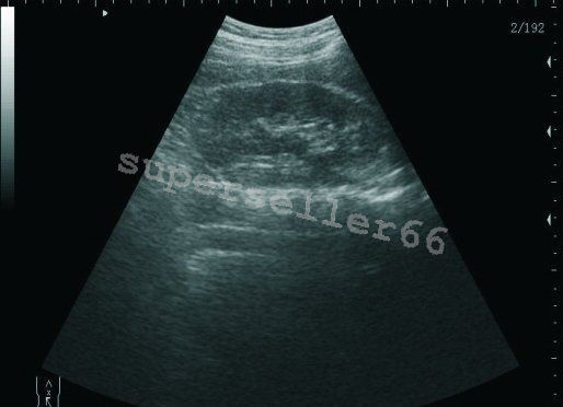Digital LCD Ultrasound Scanner B Ultrasonic Machine,Convex Probe ,Linear Probe DIAGNOSTIC ULTRASOUND MACHINES FOR SALE